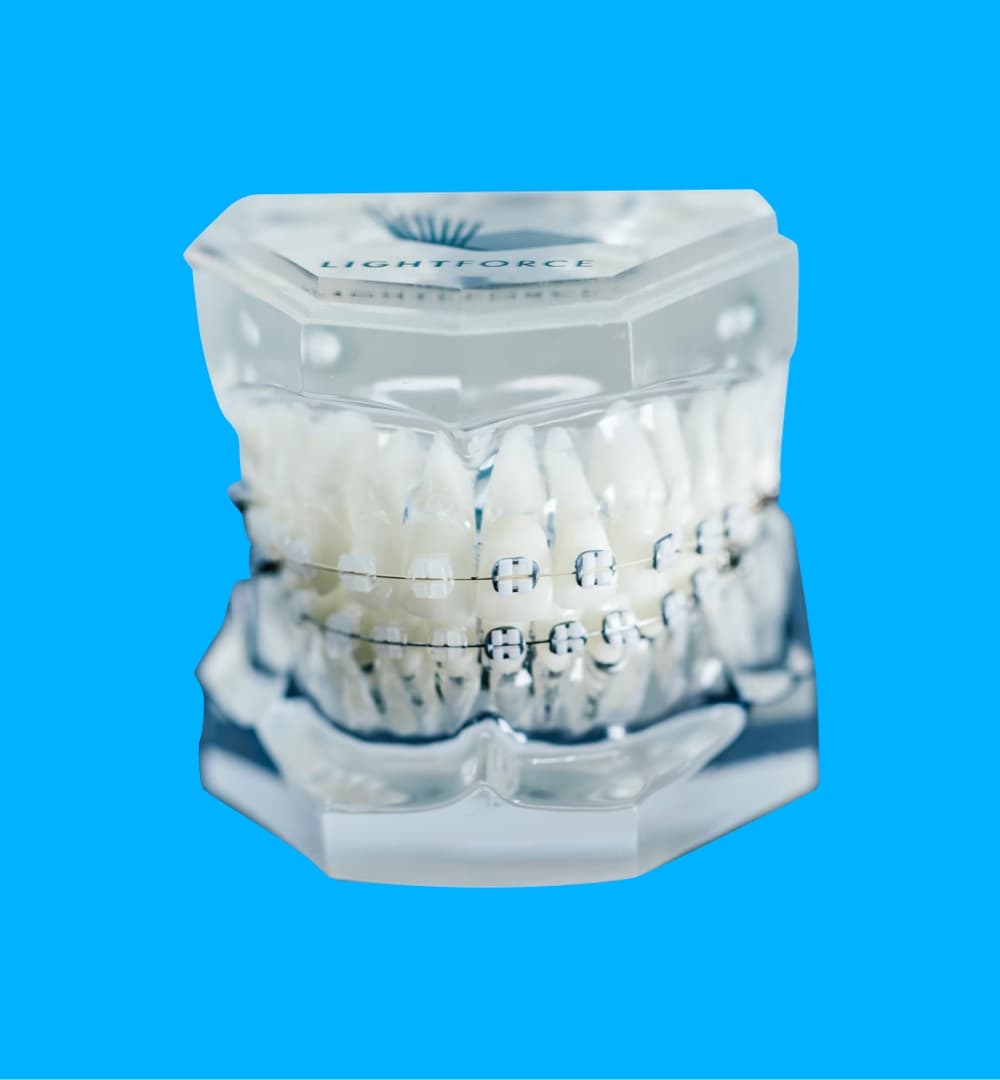 invisalign aligners on plastic model